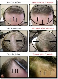 Cold Laser Hair Loss Therapy